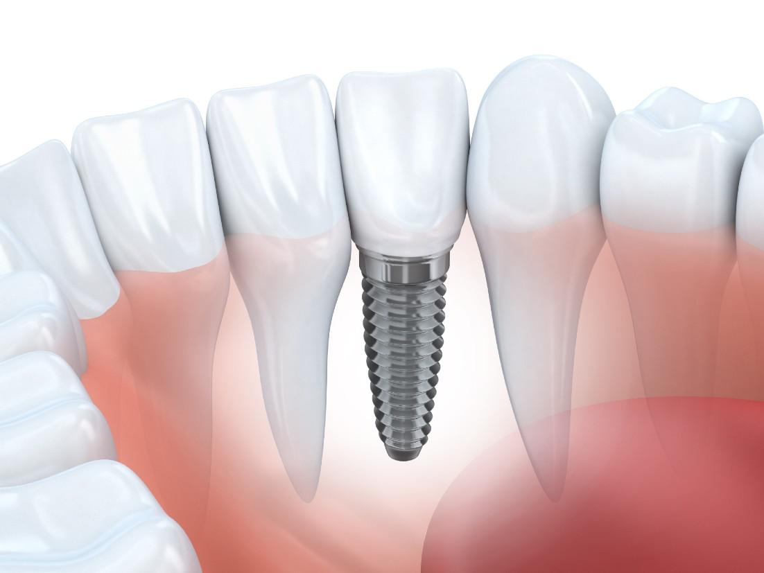 Dental Implants Westlake, OH